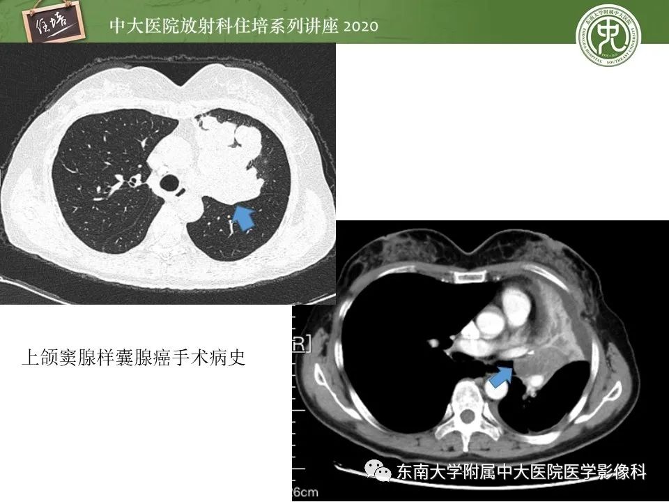 影像PPT - 【PPT】肺内常见影像征象解读 （树芽征、指套征）-49