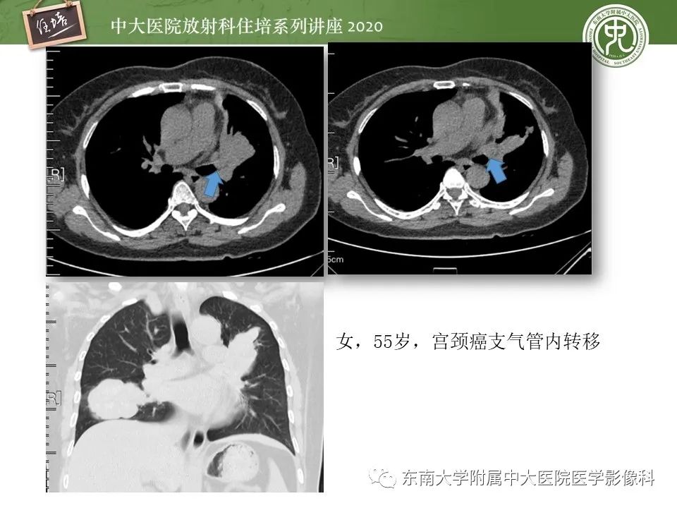 影像PPT - 【PPT】肺内常见影像征象解读 （树芽征、指套征）-50