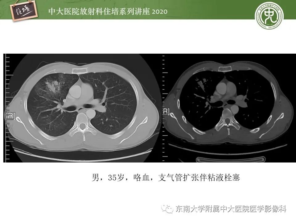 影像PPT - 【PPT】肺内常见影像征象解读 （树芽征、指套征）-51