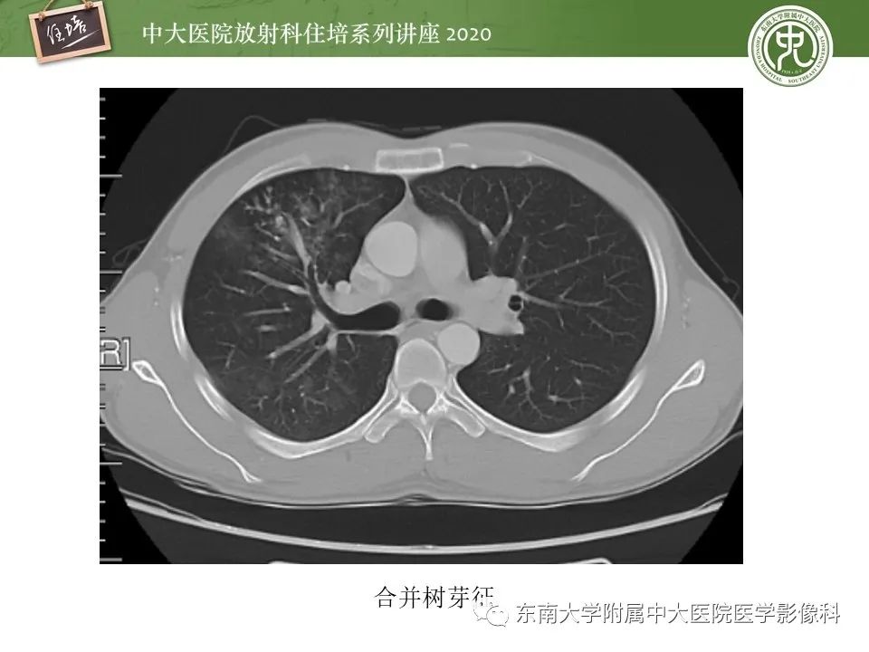 影像PPT - 【PPT】肺内常见影像征象解读 （树芽征、指套征）-52