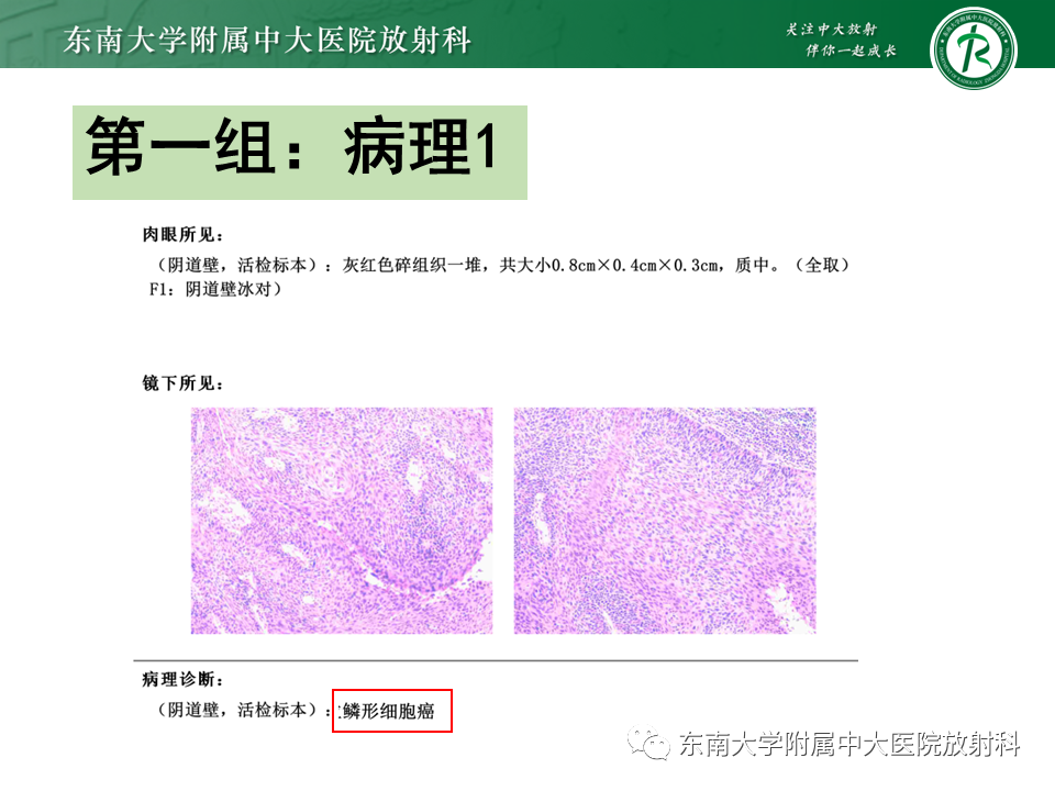 影像PPT - 【PPT】女性尿道生殖膈区占位性病变—阴道恶性肿瘤-4