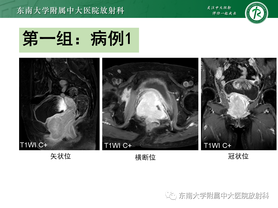影像PPT - 【PPT】女性尿道生殖膈区占位性病变—阴道恶性肿瘤-3