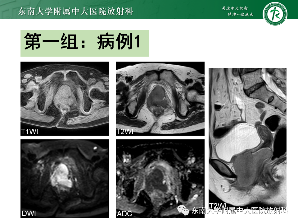 影像PPT - 【PPT】女性尿道生殖膈区占位性病变—阴道恶性肿瘤-2