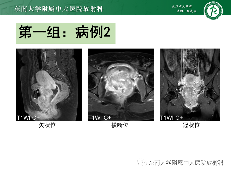 影像PPT - 【PPT】女性尿道生殖膈区占位性病变—阴道恶性肿瘤-7