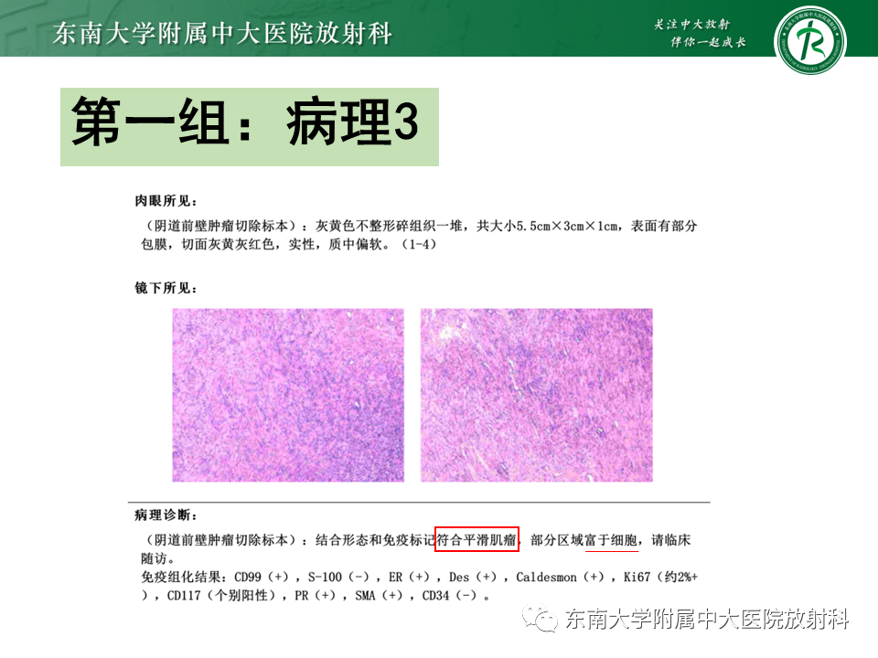 影像PPT - 【PPT】女性尿道生殖膈区占位性病变—阴道恶性肿瘤-12
