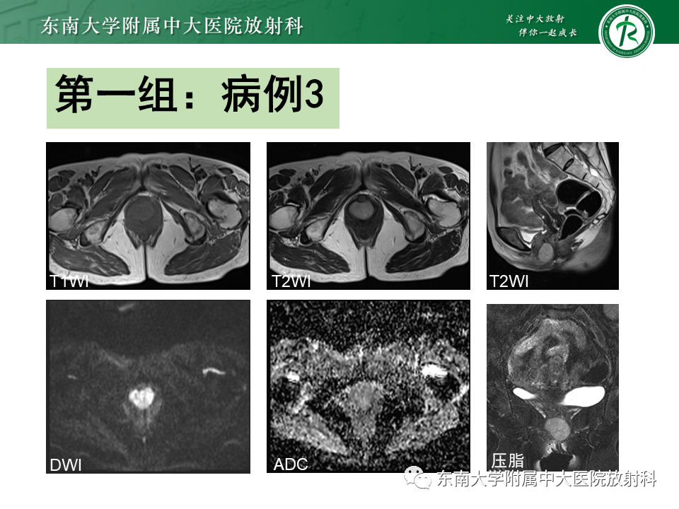 影像PPT - 【PPT】女性尿道生殖膈区占位性病变—阴道恶性肿瘤-10