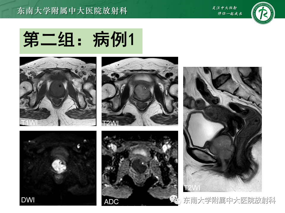 影像PPT - 【PPT】女性尿道生殖膈区占位性病变—阴道恶性肿瘤-16