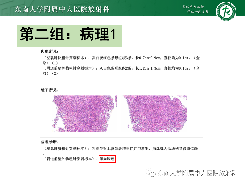 影像PPT - 【PPT】女性尿道生殖膈区占位性病变—阴道恶性肿瘤-19