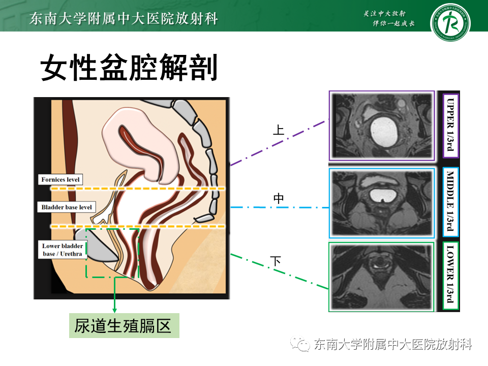 影像PPT - 【PPT】女性尿道生殖膈区占位性病变—阴道恶性肿瘤-25
