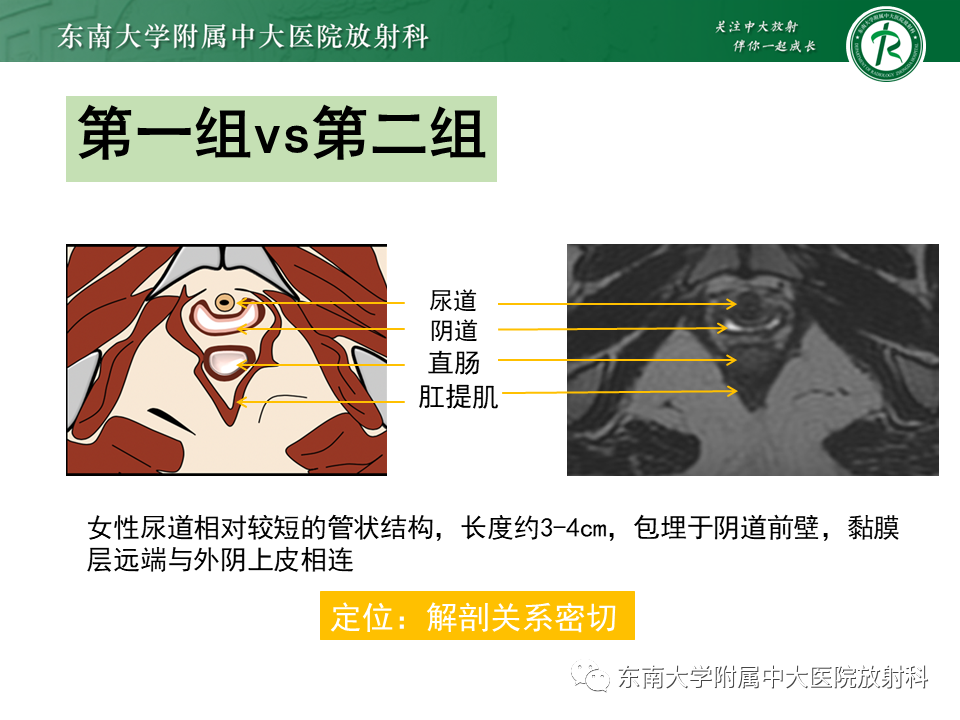 影像PPT - 【PPT】女性尿道生殖膈区占位性病变—阴道恶性肿瘤-26