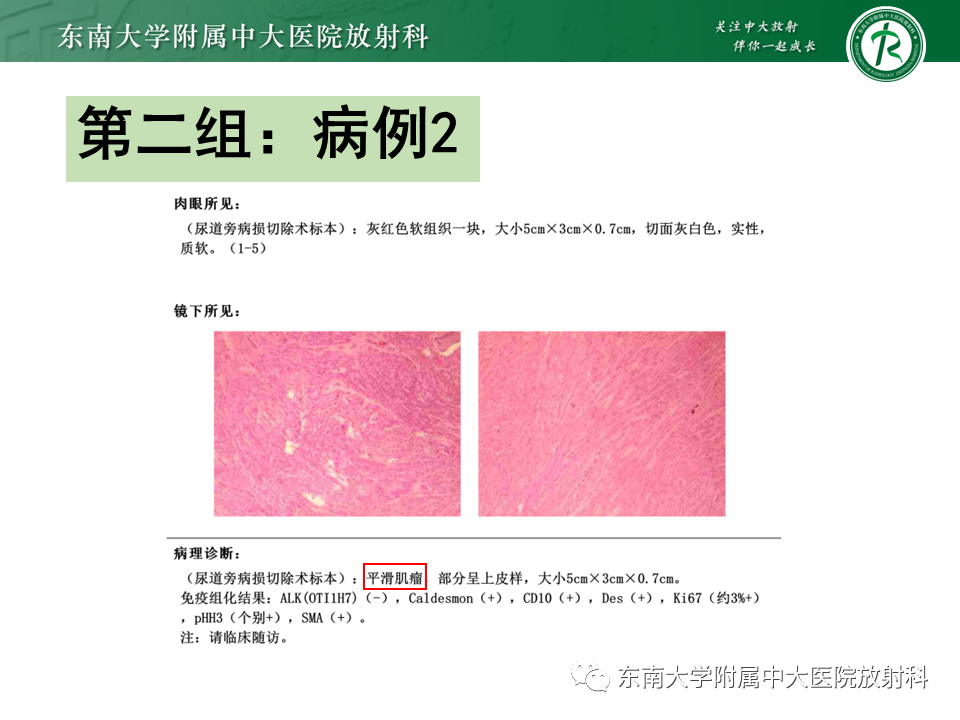 影像PPT - 【PPT】女性尿道生殖膈区占位性病变—阴道恶性肿瘤-24