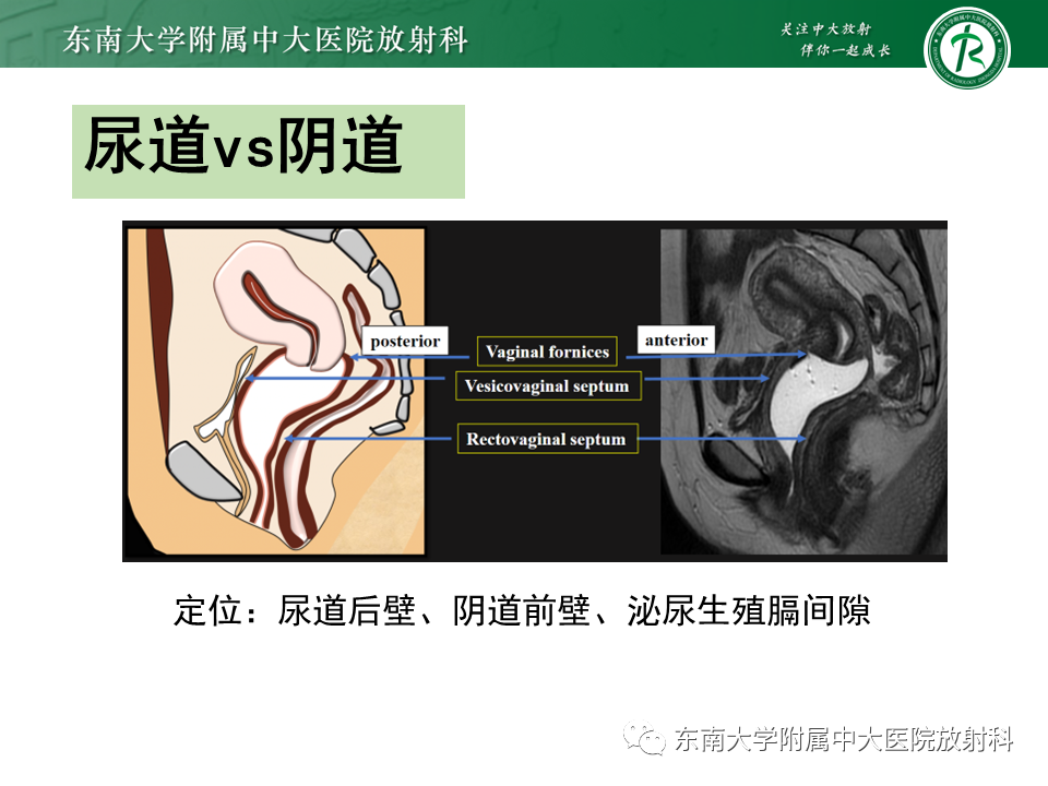 影像PPT - 【PPT】女性尿道生殖膈区占位性病变—阴道恶性肿瘤-30