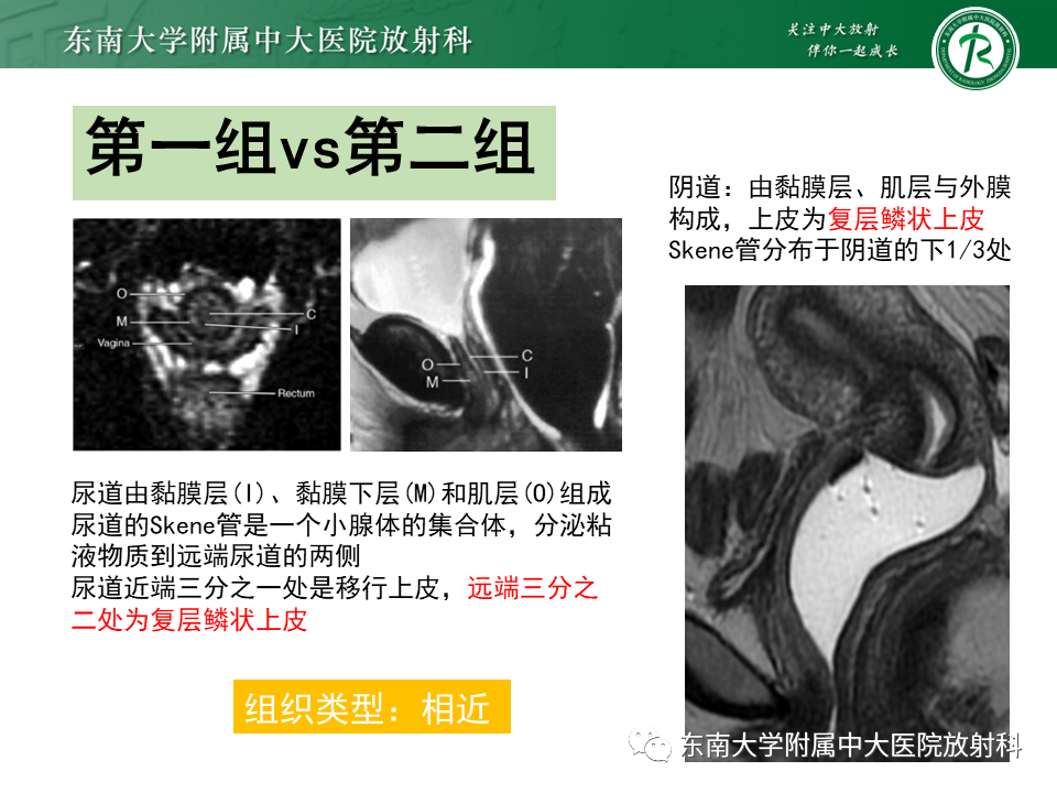 影像PPT - 【PPT】女性尿道生殖膈区占位性病变—阴道恶性肿瘤-27