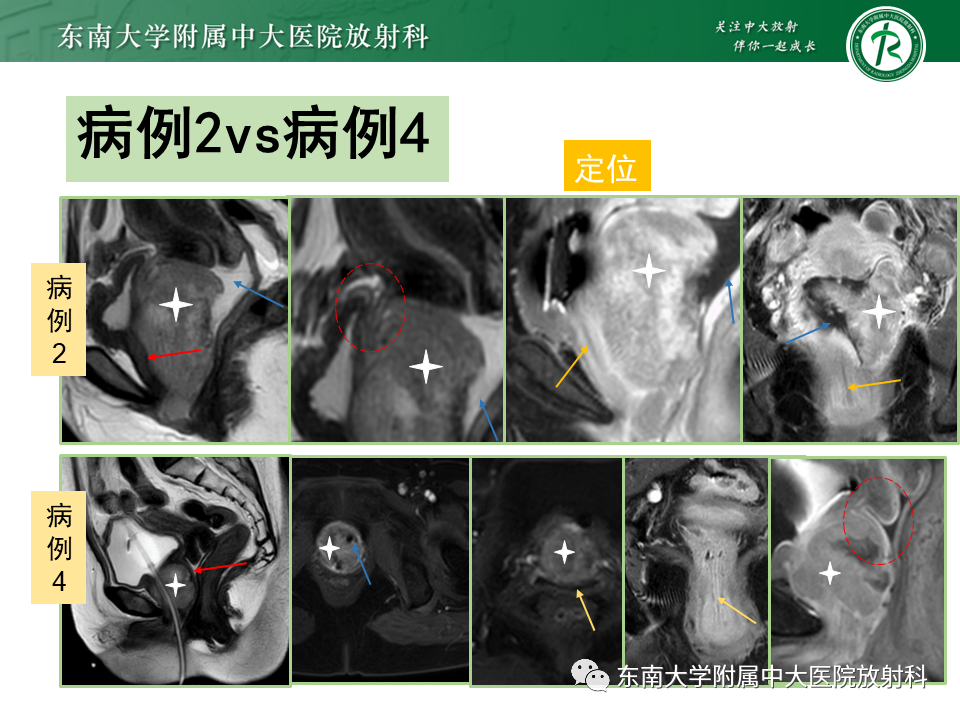 影像PPT - 【PPT】女性尿道生殖膈区占位性病变—阴道恶性肿瘤-31