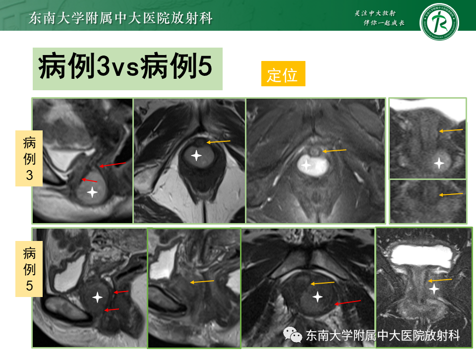 影像PPT - 【PPT】女性尿道生殖膈区占位性病变—阴道恶性肿瘤-32