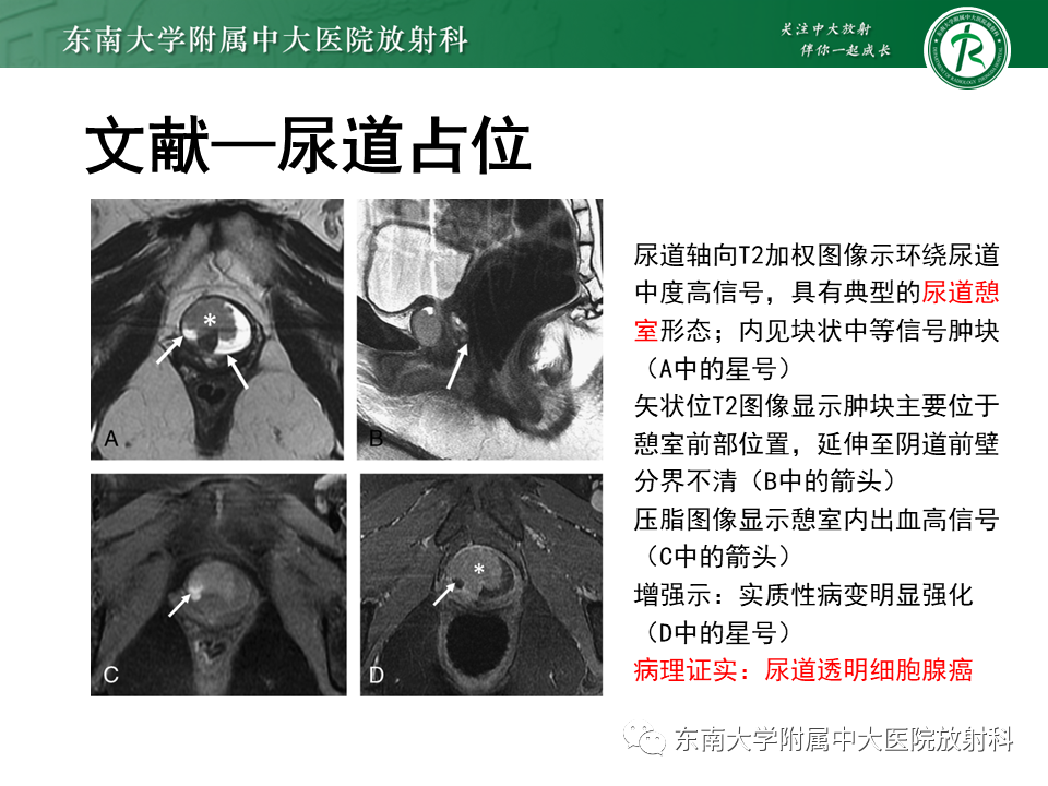 影像PPT - 【PPT】女性尿道生殖膈区占位性病变—阴道恶性肿瘤-34