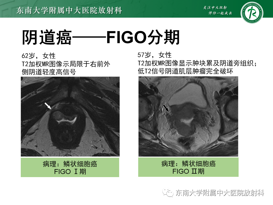 影像PPT - 【PPT】女性尿道生殖膈区占位性病变—阴道恶性肿瘤-43