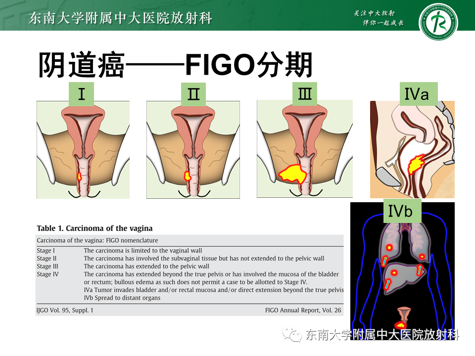 影像PPT - 【PPT】女性尿道生殖膈区占位性病变—阴道恶性肿瘤-40
