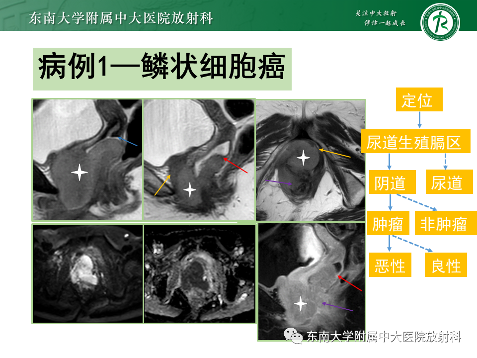 影像PPT - 【PPT】女性尿道生殖膈区占位性病变—阴道恶性肿瘤-45