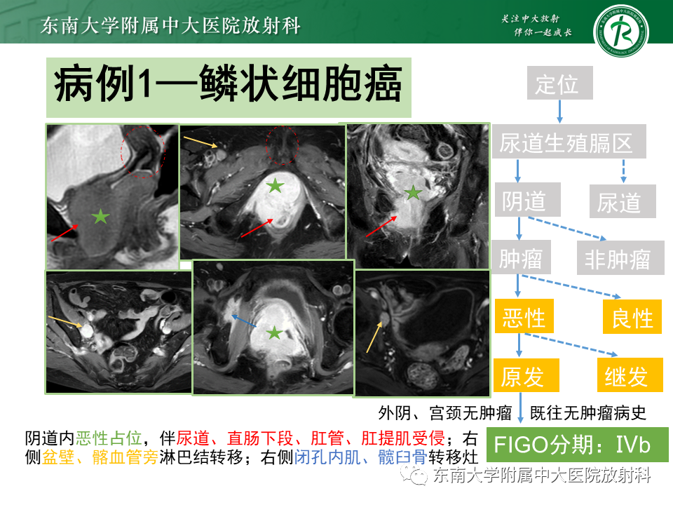 影像PPT - 【PPT】女性尿道生殖膈区占位性病变—阴道恶性肿瘤-46