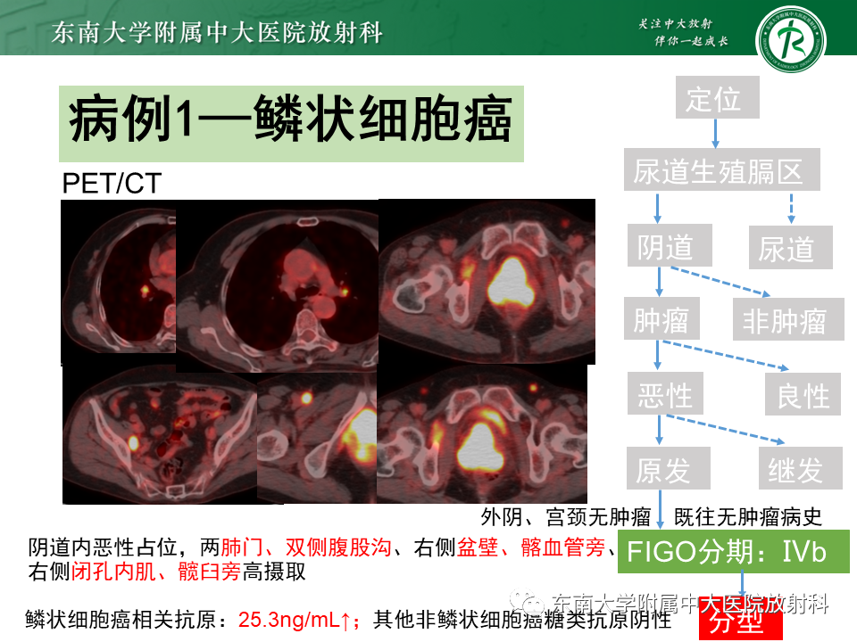影像PPT - 【PPT】女性尿道生殖膈区占位性病变—阴道恶性肿瘤-47
