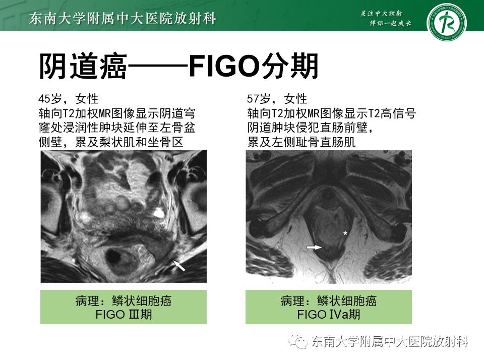 影像PPT - 【PPT】女性尿道生殖膈区占位性病变—阴道恶性肿瘤-44
