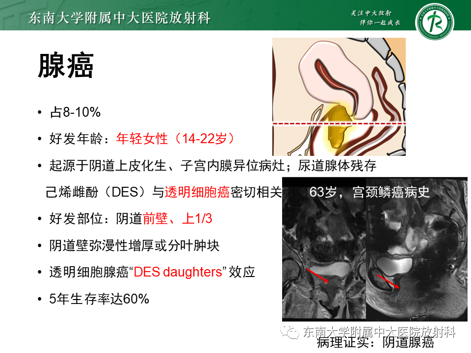 影像PPT - 【PPT】女性尿道生殖膈区占位性病变—阴道恶性肿瘤-50