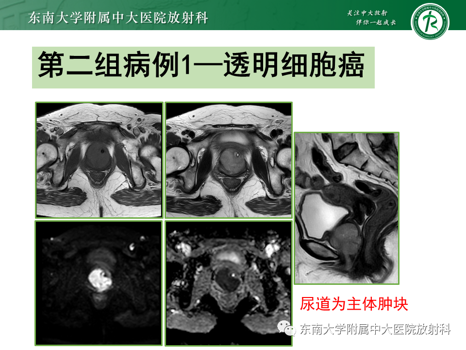 影像PPT - 【PPT】女性尿道生殖膈区占位性病变—阴道恶性肿瘤-51