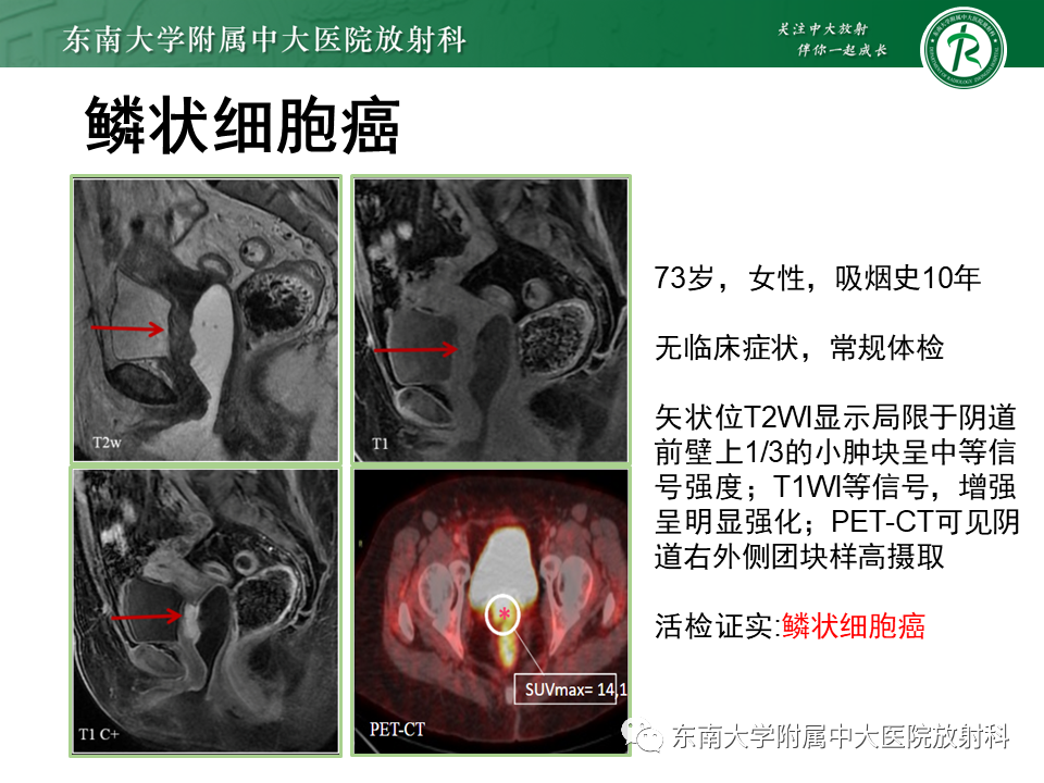 影像PPT - 【PPT】女性尿道生殖膈区占位性病变—阴道恶性肿瘤-49