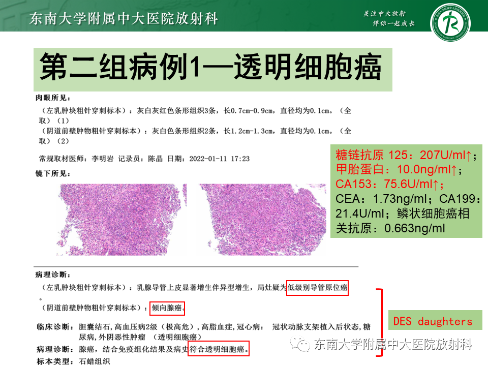 影像PPT - 【PPT】女性尿道生殖膈区占位性病变—阴道恶性肿瘤-52