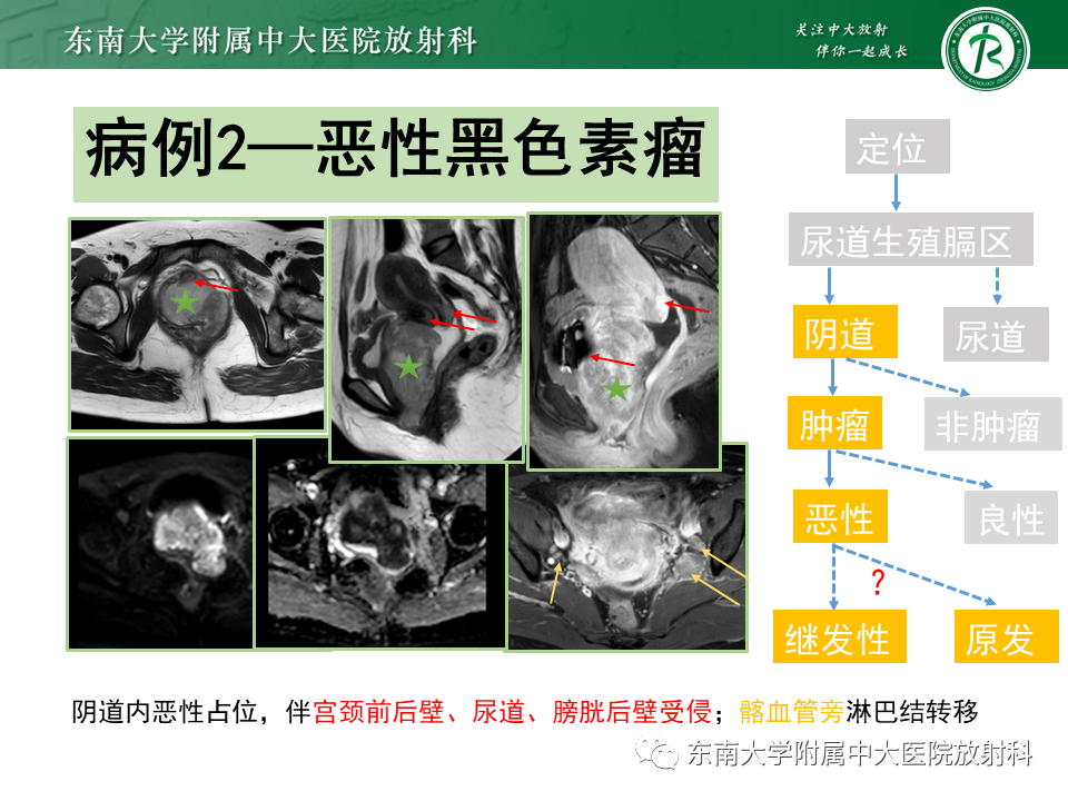 影像PPT - 【PPT】女性尿道生殖膈区占位性病变—阴道恶性肿瘤-56