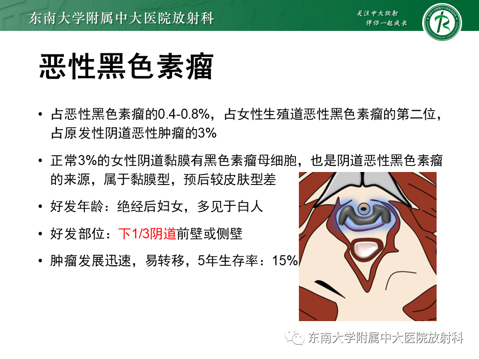 影像PPT - 【PPT】女性尿道生殖膈区占位性病变—阴道恶性肿瘤-58