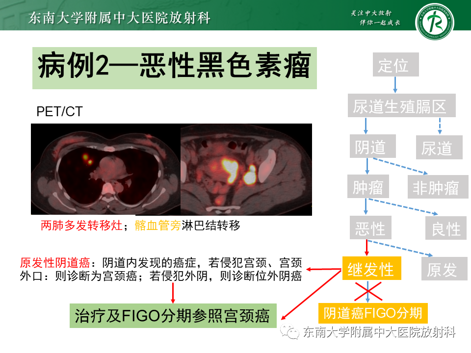 影像PPT - 【PPT】女性尿道生殖膈区占位性病变—阴道恶性肿瘤-57
