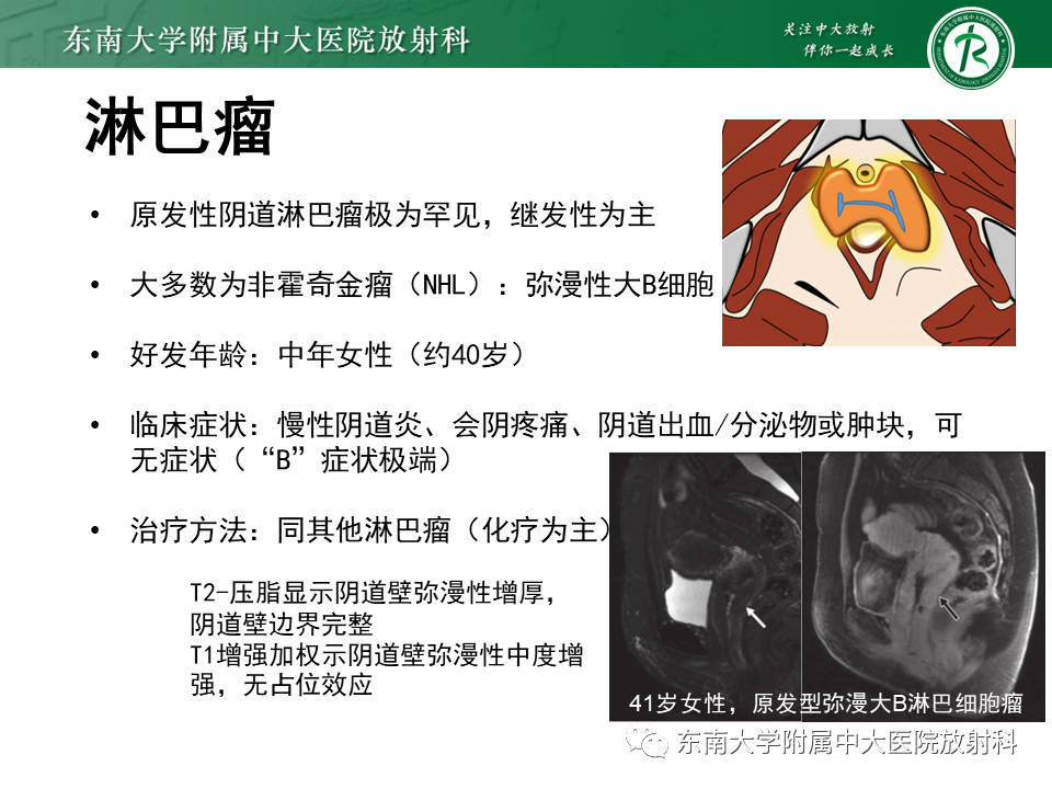 影像PPT - 【PPT】女性尿道生殖膈区占位性病变—阴道恶性肿瘤-62