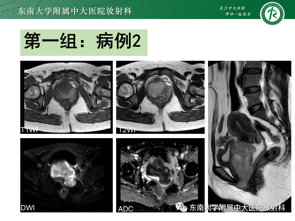 影像PPT - 【PPT】女性尿道生殖膈区占位性病变—阴道恶性肿瘤-1