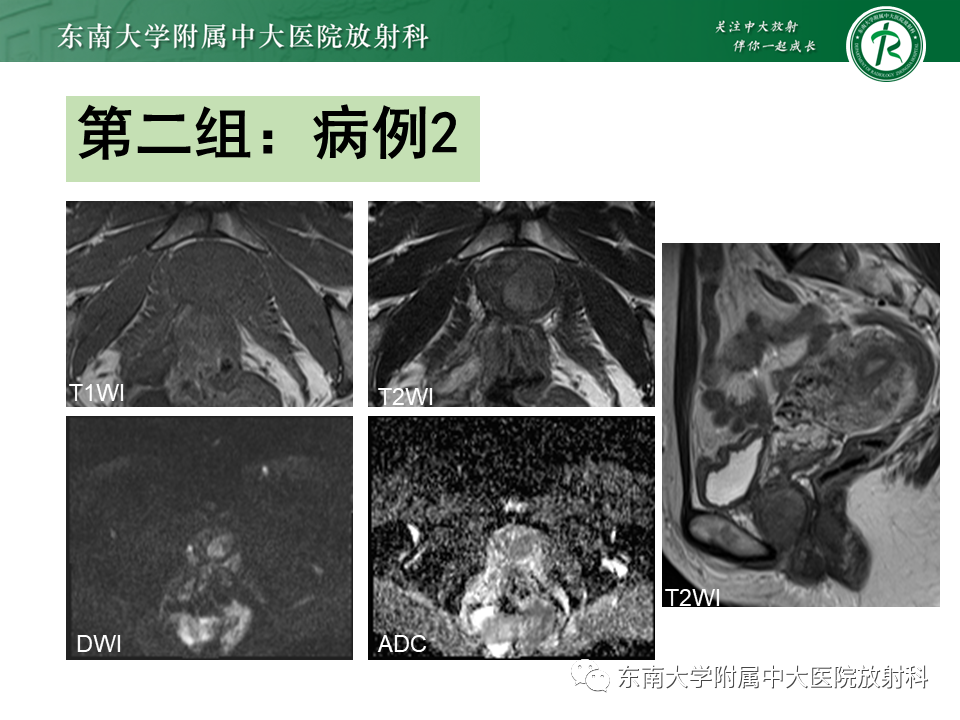 影像PPT - 【PPT】女性尿道生殖膈区占位性病变—阴道恶性肿瘤-3
