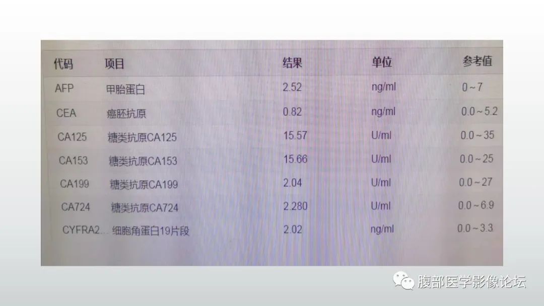 影像PPT - 【病例】腹腔后神经鞘瘤1例CT-3 影像PPT - 【病例】腹腔后神经鞘瘤1例CT-3