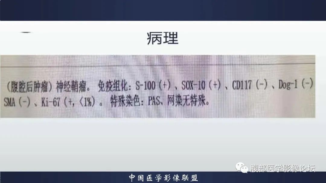 影像PPT - 【病例】腹腔后神经鞘瘤1例CT-13 影像PPT - 【病例】腹腔后神经鞘瘤1例CT-13