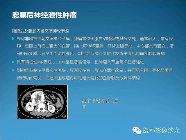 影像PPT - 【病例】腹腔后神经鞘瘤1例CT-19 影像PPT - 【病例】腹腔后神经鞘瘤1例CT-19