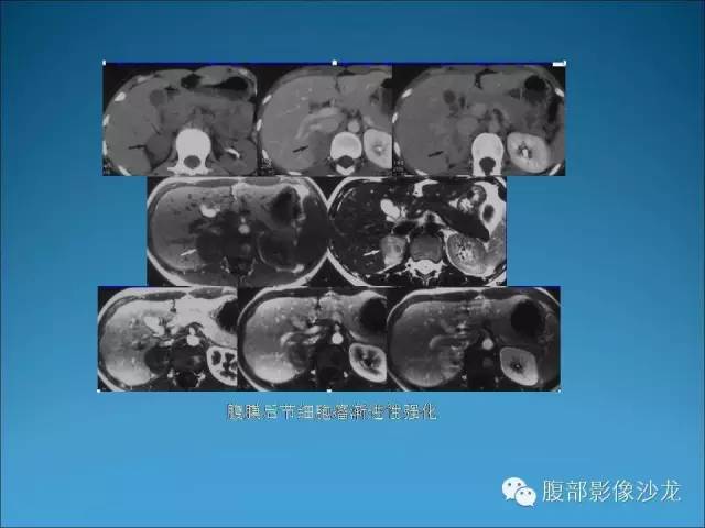 影像PPT - 【病例】腹腔后神经鞘瘤1例CT-21 影像PPT - 【病例】腹腔后神经鞘瘤1例CT-21