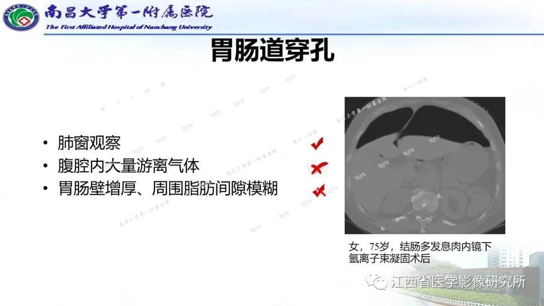 影像PPT - 【PPT】消化道急腹症的CT诊断-5