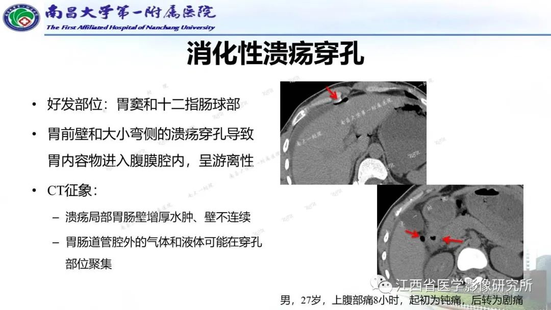 影像PPT - 【PPT】消化道急腹症的CT诊断-6