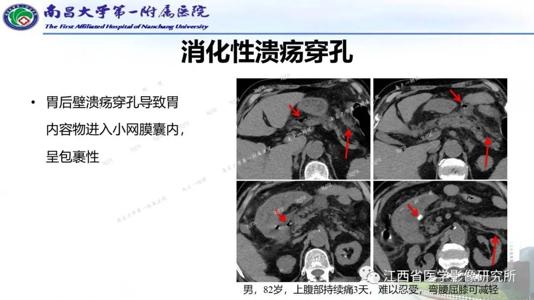 影像PPT - 【PPT】消化道急腹症的CT诊断-7