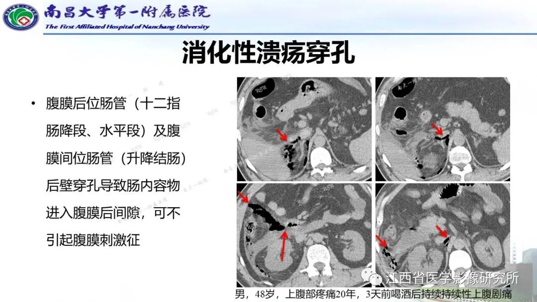 影像PPT - 【PPT】消化道急腹症的CT诊断-8