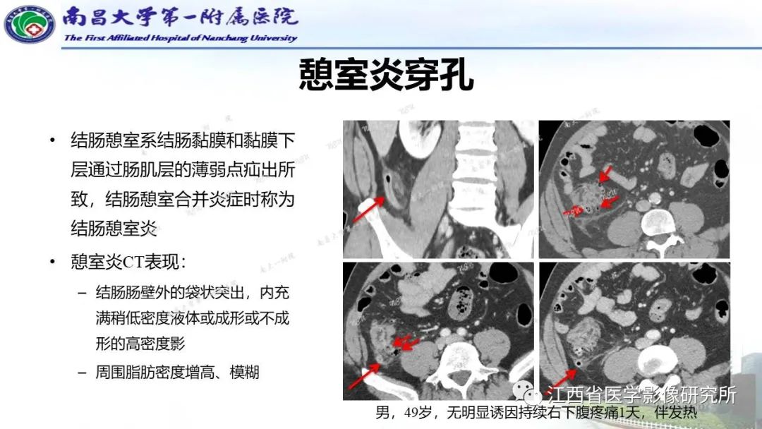 影像PPT - 【PPT】消化道急腹症的CT诊断-10