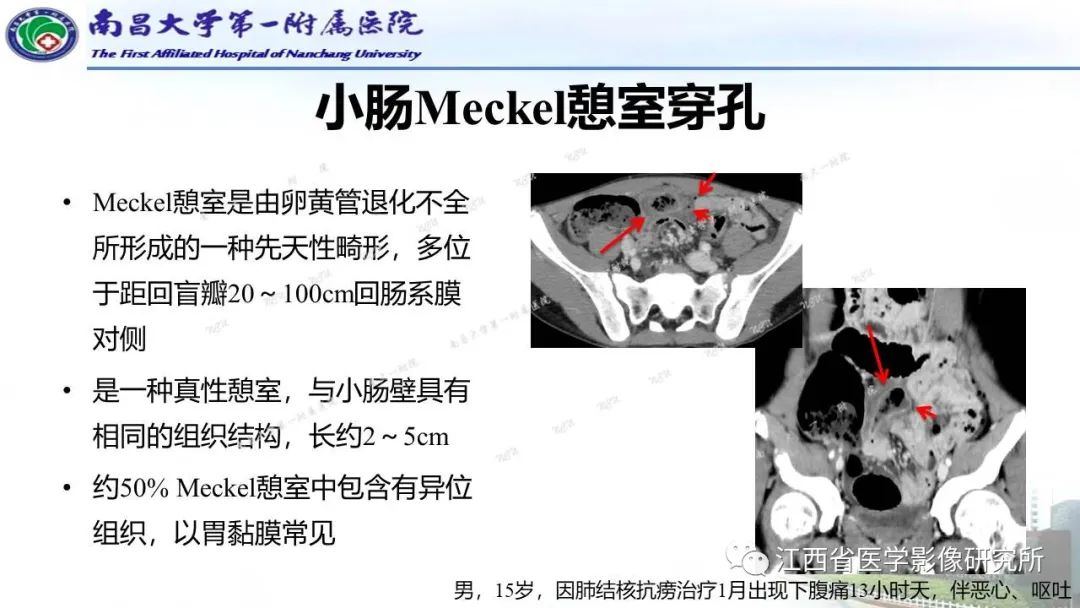 影像PPT - 【PPT】消化道急腹症的CT诊断-11