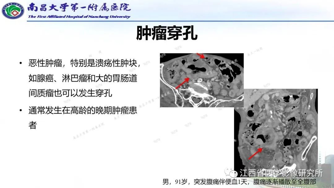 影像PPT - 【PPT】消化道急腹症的CT诊断-12