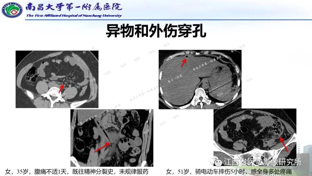 影像PPT - 【PPT】消化道急腹症的CT诊断-13