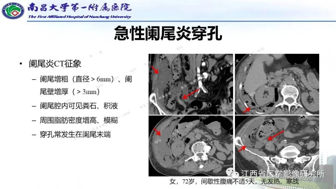 影像PPT - 【PPT】消化道急腹症的CT诊断-9