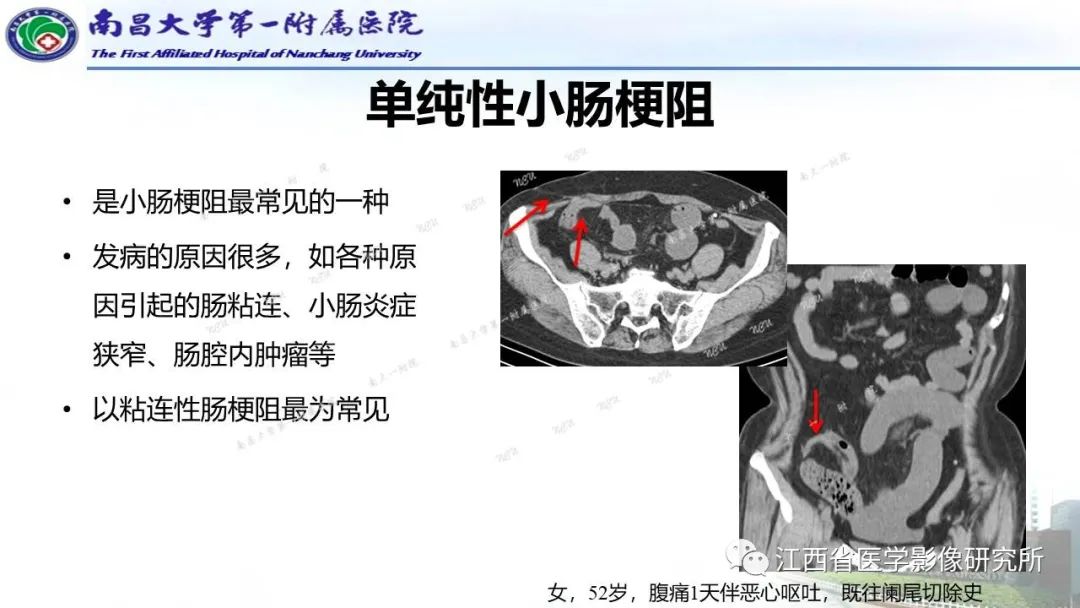 影像PPT - 【PPT】消化道急腹症的CT诊断-17